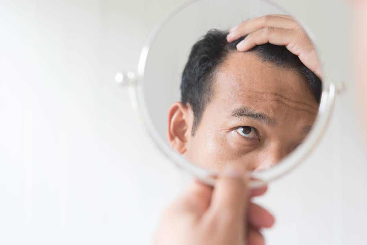 Some Common Causes of Excessive Hair Loss in Men
